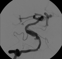 Cerebral angiogram of VB junction aneurysm